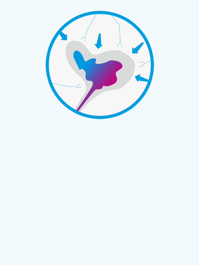 Use to stress incontinence